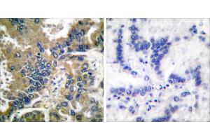 Cl-peptide - +Immunohistochemical analysis of paraffin-embedded human lung carcinoma tissue using Caspase 1 (Cleaved-Asp210) antibody. (Caspase 1 anticorps  (Cleaved-Asp210))