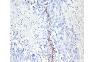 Immunohistochemistry of paraffin-embedded human bladder cancer using ABIN7164742 at dilution of 1:100 (Ki-67 anticorps  (AA 3120-3256))