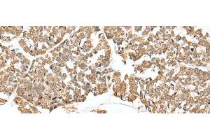 Immunohistochemistry of paraffin-embedded Human esophagus cancer tissue using NDUFB3 Polyclonal Antibody at dilution of 1:25(x200) (NDUFB3 anticorps)