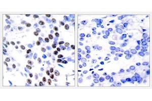Immunohistochemical analysis of paraffin-embedded human breast carcinoma tissue using c-Jun (Ab-93) antibody (E021022). (C-JUN anticorps)