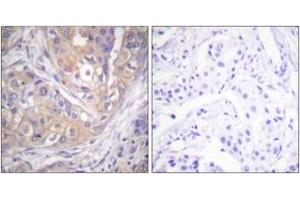 Immunohistochemistry analysis of paraffin-embedded human breast carcinoma, using Lck (Phospho-Tyr505) Antibody. (LCK anticorps  (pTyr505))
