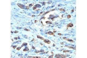 IHC testing of FFPE gastric carcinoma with Cdc20 antibody (clone AR12) (CDC20 anticorps)