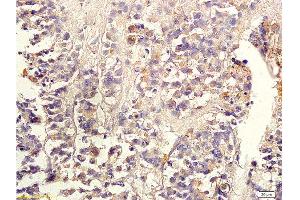 Formalin-fixed and paraffin embedded human colon carcinoma labeled with Anti-TGF-beta-2 Polyclonal Antibody, Unconjugated 1:300 followed by conjugation to the secondary antibody and DAB staining (TGF beta 2 Propeptide (AA 154-197) anticorps)