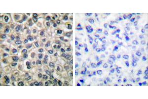 Peptide - +Immunohistochemical analysis of paraffin-embedded human breast carcinoma tissue using Catenin-γ antibody. (JUP anticorps)