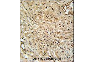 RPA43 Antibody immunohistochemistry analysis in formalin fixed and paraffin embedded human cervix carcinoma followed by peroxidase conjugation of the secondary antibody and DAB staining. (TWIST Neighbor anticorps  (C-Term))
