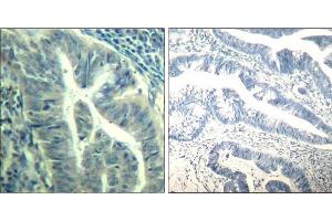 Immunohistochemical analysis of paraffin-embedded human colon carcinoma tissue using CDK6 (phospho-Tyr24) Antibody (E011543). (CDK6 anticorps  (pTyr24))
