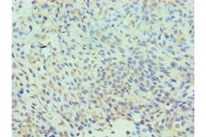 Immunohistochemistry of paraffin-embedded human breast cancer using ABIN7147585 at dilution of 1:100 (CLIC1 anticorps  (AA 42-241))