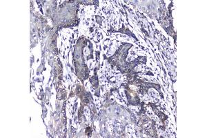 IHC testing of FFPE human glioma with L1CAM antibody at 1ug/ml. (L1CAM anticorps)