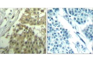Immunohistochemical analysis of paraffin-embedded human breast carcinoma tissue using cdc2 (Ab-19) Antibody (E021529). (CDK1 anticorps)