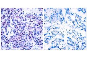 Immunohistochemical analysis of paraffin-embedded human breast carcinoma tissue using JunD (phospho- Ser255) antibody (E011028). (JunD anticorps  (pSer255))