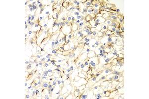 Immunohistochemistry of paraffin-embedded human kidney cancer using VANGL2 antibody (ABIN5975655) at dilution of 1/100 (40x lens). (VANGL2 anticorps)