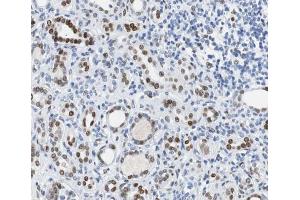 ABIN6267500 at 1/100 staining human Kidney carcinoma tissue sections by IHC-P. (BRCA1 anticorps  (pSer1524))