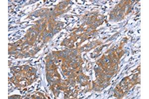 The image on the left is immunohistochemistry of paraffin-embedded Human cervical cancer tissue using ABIN7130635(PITPNM1 Antibody) at dilution 1/40, on the right is treated with fusion protein. (PITPNM1 anticorps)