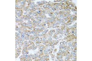 Immunohistochemistry of paraffin-embedded human liver cancer using NDUFA2 antibody (ABIN5974497) at dilution of 1/100 (40x lens). (NDUFA2 anticorps)