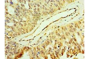 Immunohistochemistry of paraffin-embedded human endometrial cancer using ABIN7150705 at dilution of 1:100 (MAP2K3 anticorps  (AA 1-170))