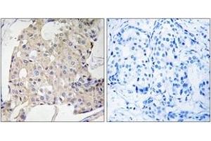 Immunohistochemistry analysis of paraffin-embedded human breast carcinoma tissue, using NDRG3 Antibody. (NDRG3 anticorps  (AA 206-255))