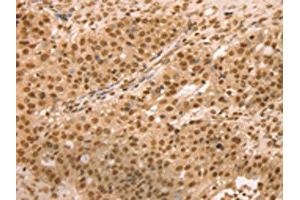 The image on the left is immunohistochemistry of paraffin-embedded Human breast cancer tissue using ABIN7131133(SNX8 Antibody) at dilution 1/25, on the right is treated with fusion protein. (SNX8 anticorps)