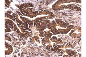 IHC-P Image PRK2 antibody [N1N3] detects PRK2 protein at cytosol on human colon carcinoma by immunohistochemical analysis. (PKN2 anticorps)