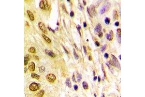 Immunohistochemical analysis of Histone H4 (AcK5) staining in human lung cancer formalin fixed paraffin embedded tissue section. (Histone H4 anticorps  (acLys5, N-Term))