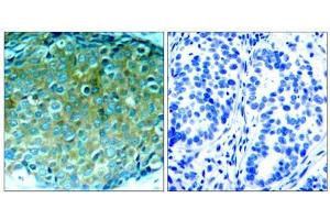 Immunohistochemical analysis of paraffin-embedded human breast carcinoma tissue, using PAK1 (Ab-212) antibody (E021160). (PAK1 anticorps)