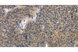 Immunohistochemistry of paraffin-embedded Human liver cancer tissue using COL4A2 Polyclonal Antibody at dilution 1:70 (COL4a2 anticorps)