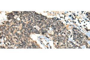 Immunohistochemistry of paraffin-embedded Human lung cancer tissue using CCNB1IP1 Polyclonal Antibody at dilution of 1:30(x200) (CCNB1IP1 anticorps)