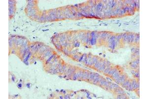 Immunohistochemical of paraffin-embedded Human Colon cancer tissue using ABIN7145293 at dilution of 1:200 (BCL2L1 anticorps)