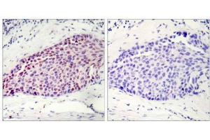 Immunohistochemical analysis of paraffin-embedded human breast carcinoma tissue using ATF-2 (Ab-112 or 94) antibody (E021033). (ATF2 anticorps)