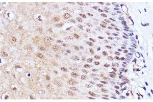 Immunohistochemistry of paraffin-embedded Human esophageal using BRD4 Polyclonal Antibody at dilution of 1:100 (40x lens). (BRD4 anticorps)