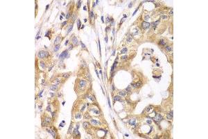 Immunohistochemistry of paraffin-embedded human liver cancer using TXNRD2 antibody. (TXNRD2 anticorps  (AA 100-310))