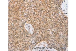 Immunohistochemistry of Human lung cancer using SERPINE2 Polyclonal Antibody at dilution of 1:20 (SERPINE2 anticorps)