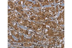 Immunohistochemistry of Human cervical cancer using GCK Polyclonal Antibody at dilution of 1:60 (GCK anticorps)