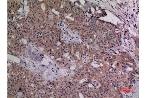 Immunohistochemical analysis of paraffin-embedded human-breast-cancer, antibody was diluted at 1:100. (IL-4 anticorps  (Internal Region))