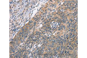 Immunohistochemistry of Human cervical cancer using PLEKHO1 Polyclonal Antibody at dilution of 1:70 (PLEKHO1 anticorps)