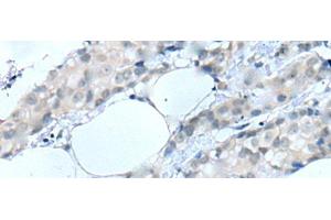 Immunohistochemistry of paraffin-embedded Human breast cancer tissue using MOG Polyclonal Antibody at dilution of 1:25(x200) (MOG anticorps)