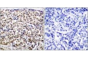 Immunohistochemistry analysis of paraffin-embedded human breast carcinoma tissue, using CREB (Ab-129) Antibody. (CREB1 anticorps  (AA 96-145))
