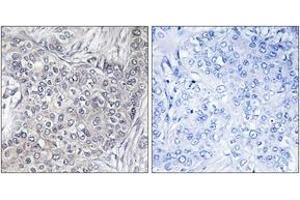 Immunohistochemistry analysis of paraffin-embedded human breast carcinoma, using 4E-BP1 (Phospho-Thr45) Antibody. (eIF4EBP1 anticorps  (pThr46))