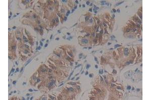 IHC-P analysis of Human Stomach cancer Tissue, with DAB staining. (HSD17B12 anticorps  (AA 1-312))