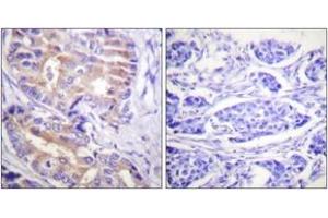 Immunohistochemistry analysis of paraffin-embedded human breast carcinoma tissue, using p70 S6 Kinase (Ab-389) Antibody. (RPS6KB1 anticorps  (AA 355-404))