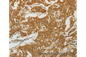 Immunohistochemistry of Human lung cancer using MC4R Polyclonal Antibody at dilution of 1:50 (MC4R anticorps)