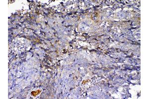 IHC analysis of IGFBP2 using anti-IGFBP2 antibody . (IGFBP2 anticorps  (AA 36-325))