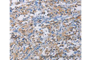 Immunohistochemistry of Human liver cancer using RICTOR Polyclonal Antibody at dilution of 1:50 (RICTOR anticorps)