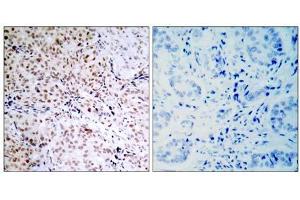 Immunohistochemical analysis of paraffin-embedded human breast carcinoma tissue, using Rb (phospho- Ser795) antibody (E011130). (Retinoblastoma 1 anticorps  (pSer795))
