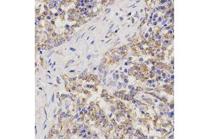 Immunohistochemistry of paraffin-embedded human lung cancer using TNFRSF1B antibody at dilution of 1:200 (x400 lens). (TNFRSF1B anticorps)