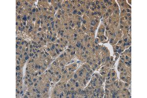 Immunohistochemistry of Human liver cancer using SIGMAR1 Polyclonal Antibody at dilution of 1:50 (SIGMAR1 anticorps)